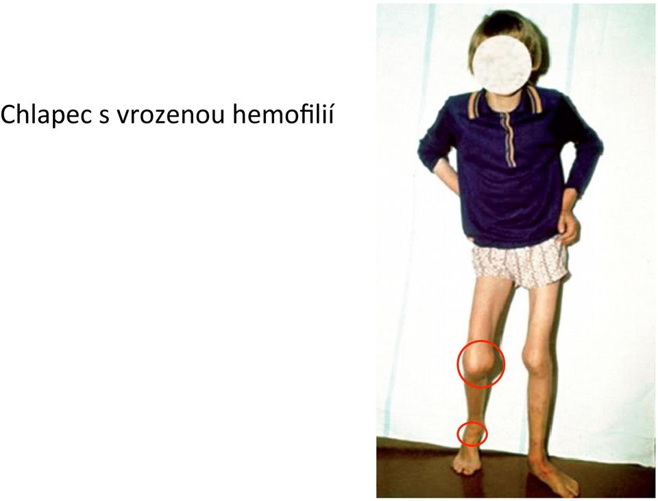 hemofilií
