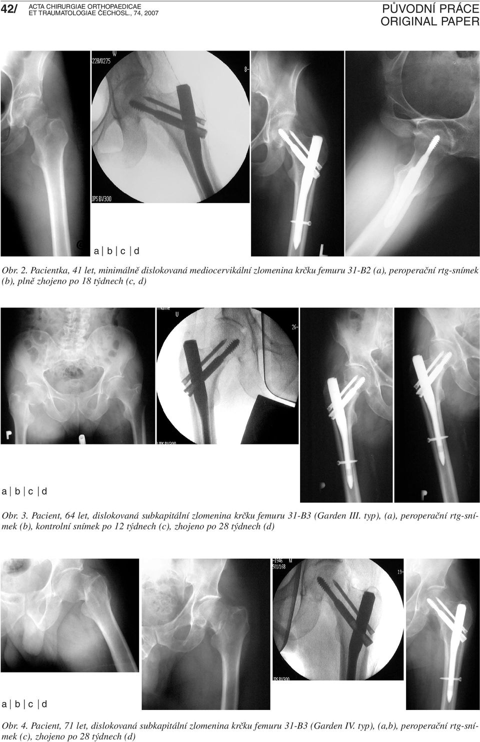 18 týdnech (c, d) a b c d Obr. 3. Pacient, 64 let, dislokovaná subkapitální zlomenina krčku femuru 31-B3 (Garden III.