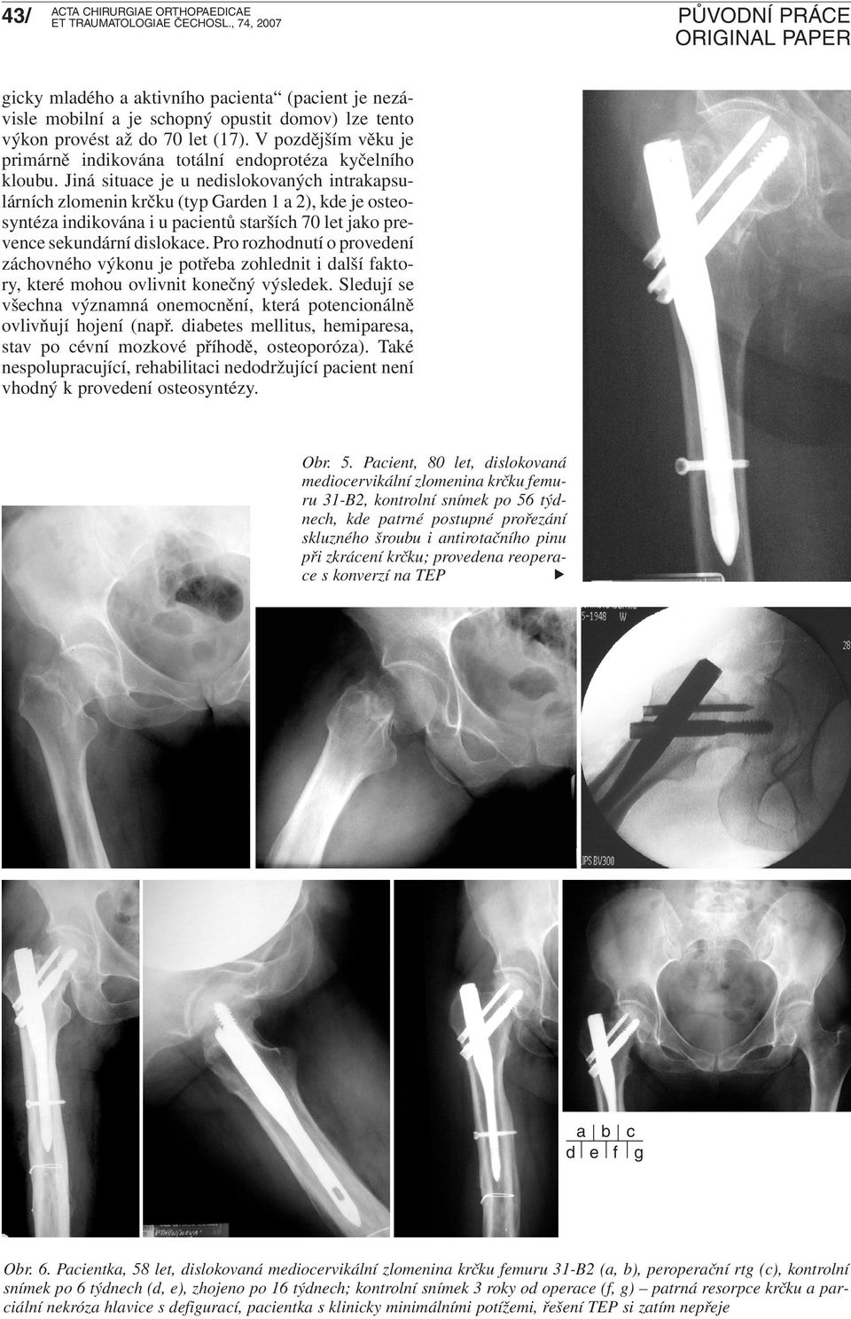 Jiná situace je u nedislokovaných intrakapsulárních zlomenin krčku (typ Garden 1 a 2), kde je osteosyntéza indikována i u pacientů starších 70 let jako prevence sekundární dislokace.