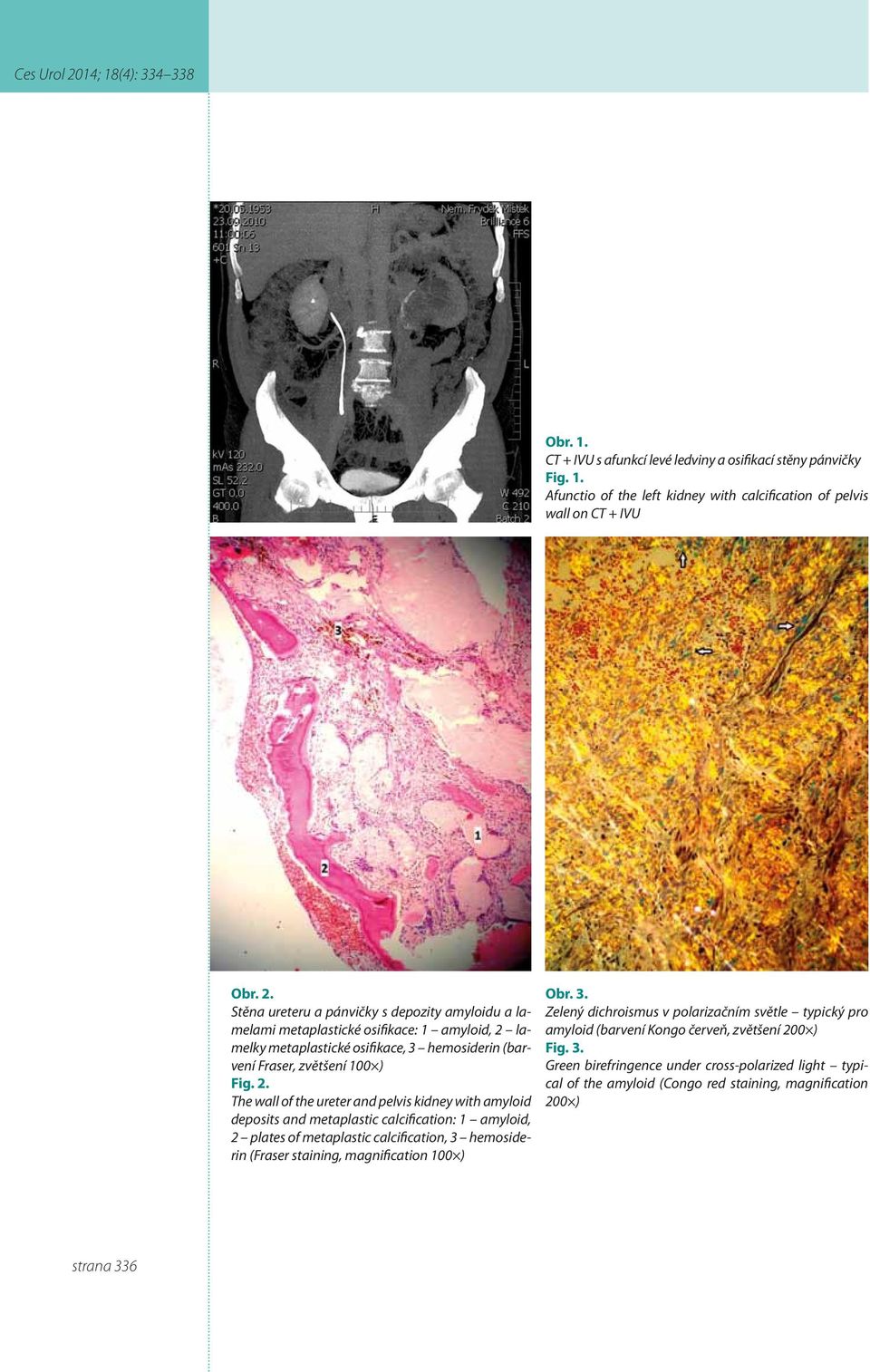 lamelky metaplastické osifikace, 3 hemosiderin (barvení Fraser, zvětšení 100 ) Fig. 2.