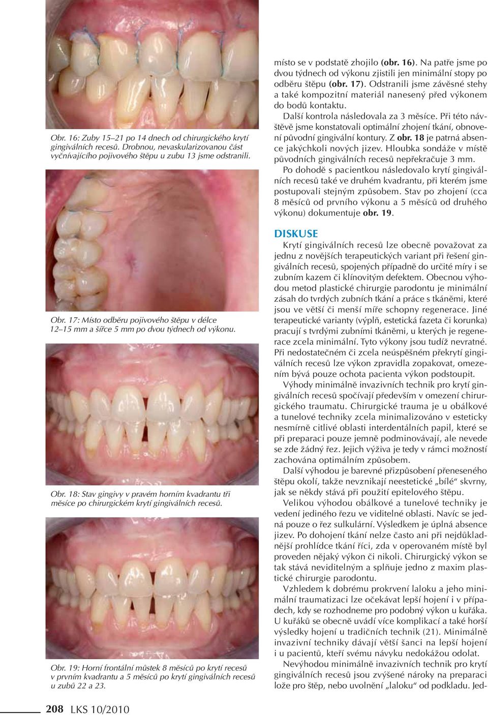 18: Stav gingivy v pravém horním kvadrantu tři měsíce po chirurgickém krytí gingiválních recesů. Obr.