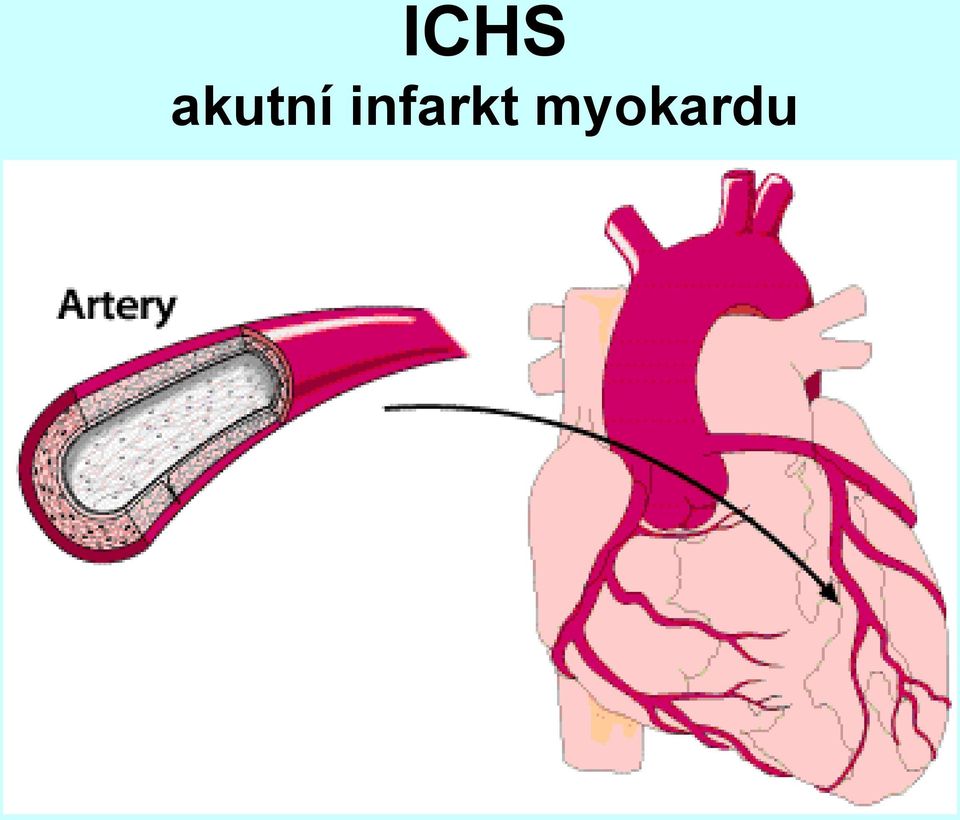 infarkt