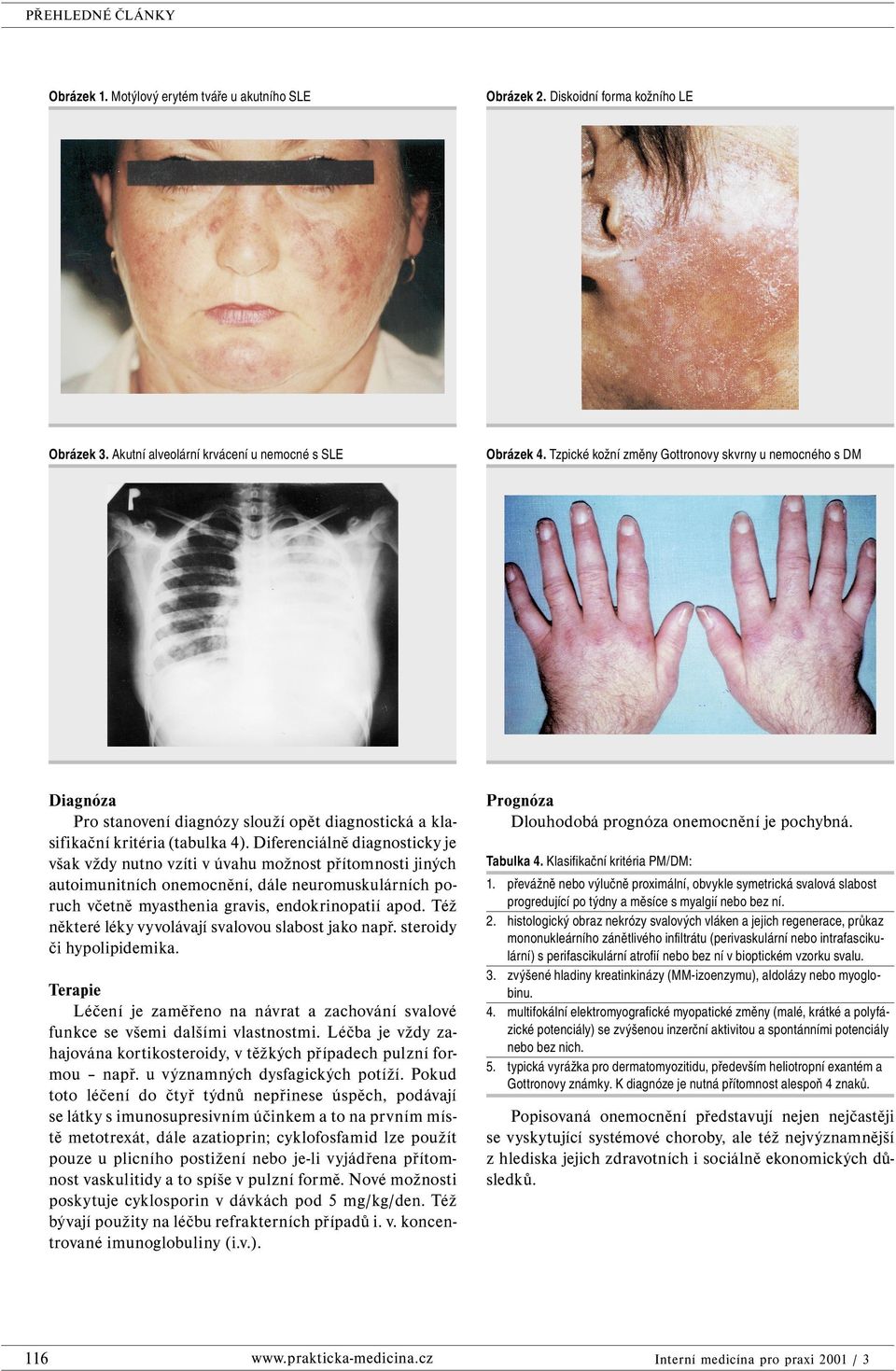 Diferenciálně diagnosticky je však vždy nutno vzíti v úvahu možnost přítomnosti jiných autoimunitních onemocnění, dále neuromuskulárních poruch včetně myasthenia gravis, endokrinopatií apod.