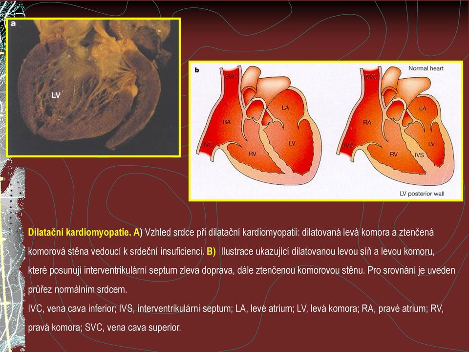 B)) Ilustrace ukazující dilatovanou levou síň a levou komoru, které posunují interventrikulární septum zleva doprava, dále