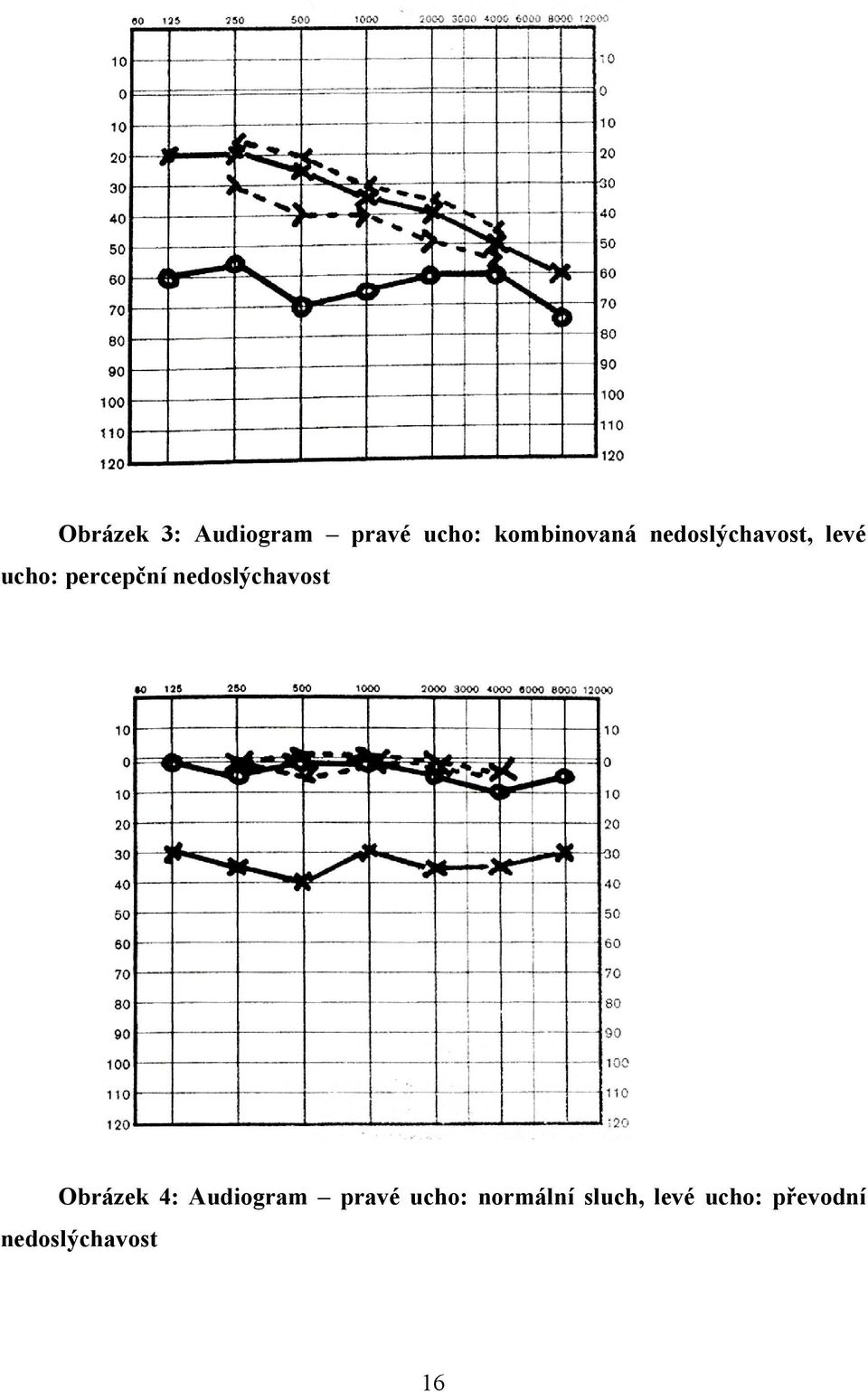 nedoslýchavost Obrázek 4: Audiogram pravé