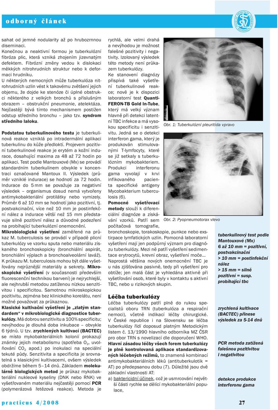 U některých nemocných může tuberkulóza nitrohrudních uzlin vést k takovému zvětšení jejich objemu, že dojde ke stenóze či úplné obstrukci některého z velkých bronchů s příslušným obrazem obstrukční