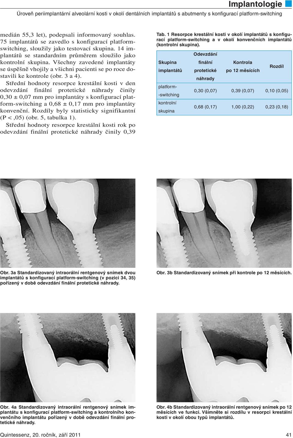 Střední hodnoty resorpce krestální kosti v den odevzdání finální protetické náhrady činily 0,30 ± 0,07 mm pro implantáty s konfigurací platform-switching a 0,68 ± 0,17 mm pro implantáty konvenční.