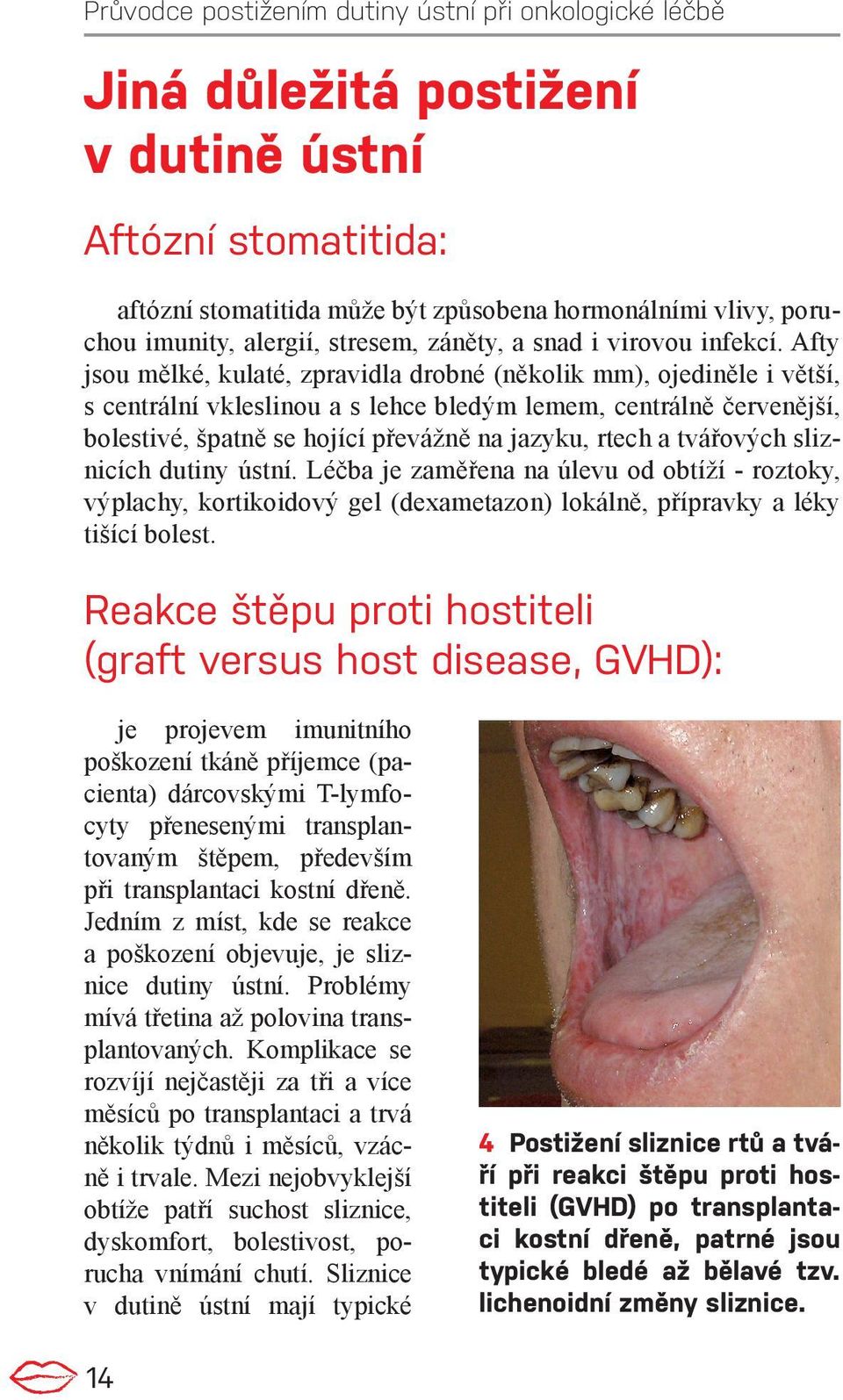 tvářových sliznicích dutiny ústní. Léčba je zaměřena na úlevu od obtíží - roztoky, výplachy, kortikoidový gel (dexametazon) lokálně, přípravky a léky tišící bolest.