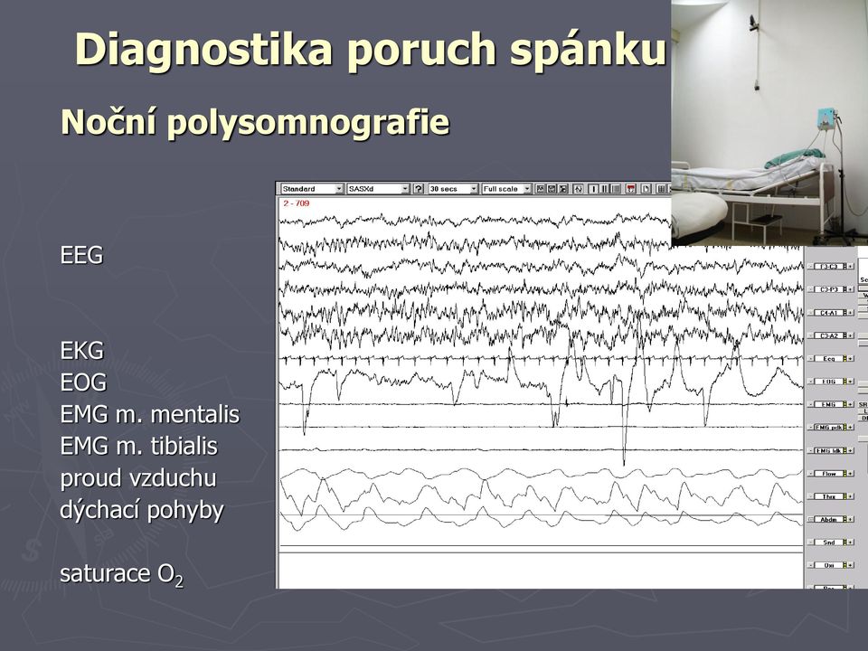 mentalis EMG m.