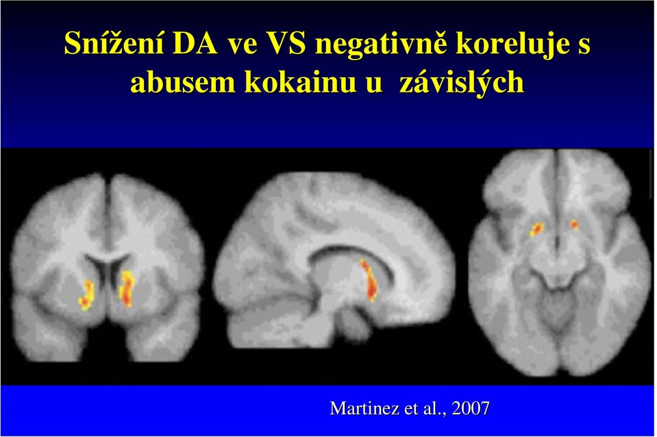 abusem kokainu u