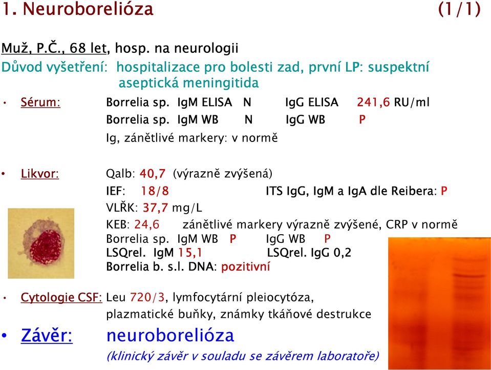 IgM WB N IgG WB P Ig, zánětlivé markery: v normě Likvor: Qalb: 40,7 (výrazně zvýšená) IEF: 18/8 ITS IgG, IgM a IgA dle Reibera: P VLŘK: 37,7 mg/l KEB: 24,6 zánětlivé