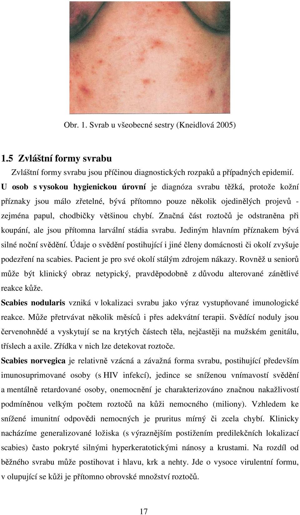 Značná část roztočů je odstraněna při koupání, ale jsou přítomna larvální stádia svrabu. Jediným hlavním příznakem bývá silné noční svědění.