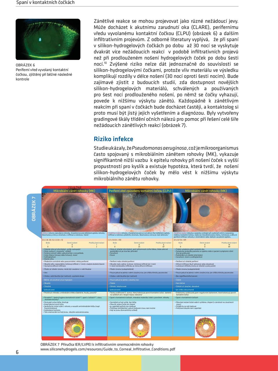 Z odborné literatury vyplývá, že při spaní v silikon-hydrogelových čočkách po dobu až 30 nocí se vyskytuje dvakrát více nežádoucích reakcí v podobě infiltrativních projevů než při prodlouženém nošení