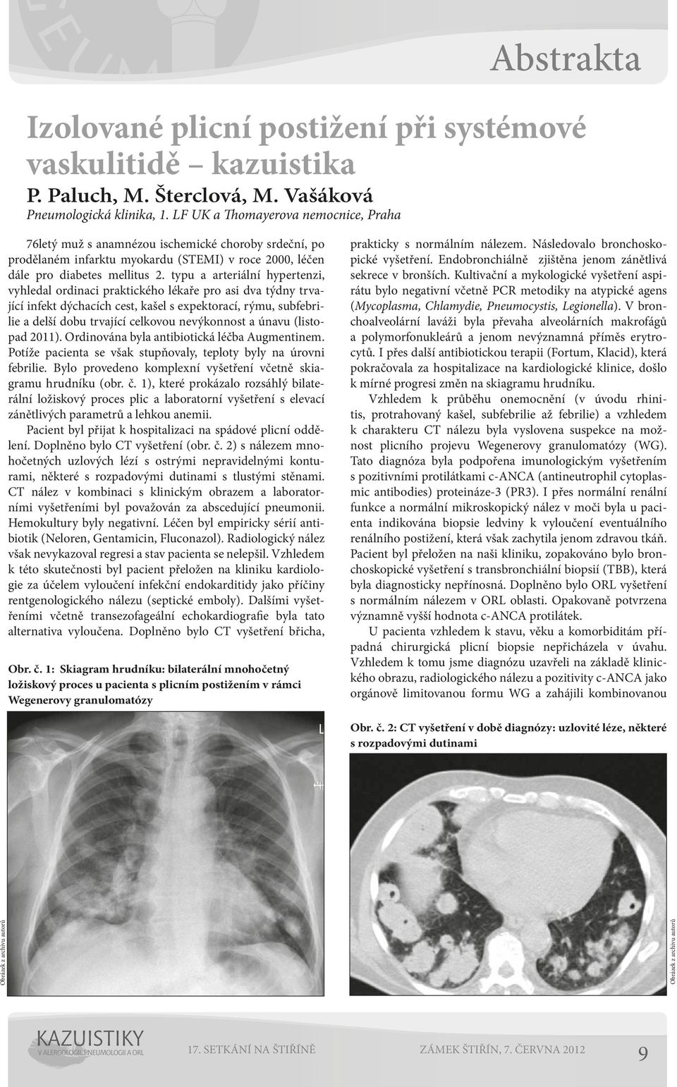 typu a arteriální hypertenzi, vyhledal ordinaci praktického lékaře pro asi dva týdny trvající infekt dýchacích cest, kašel s expektorací, rýmu, subfebrilie a delší dobu trvající celkovou nevýkonnost