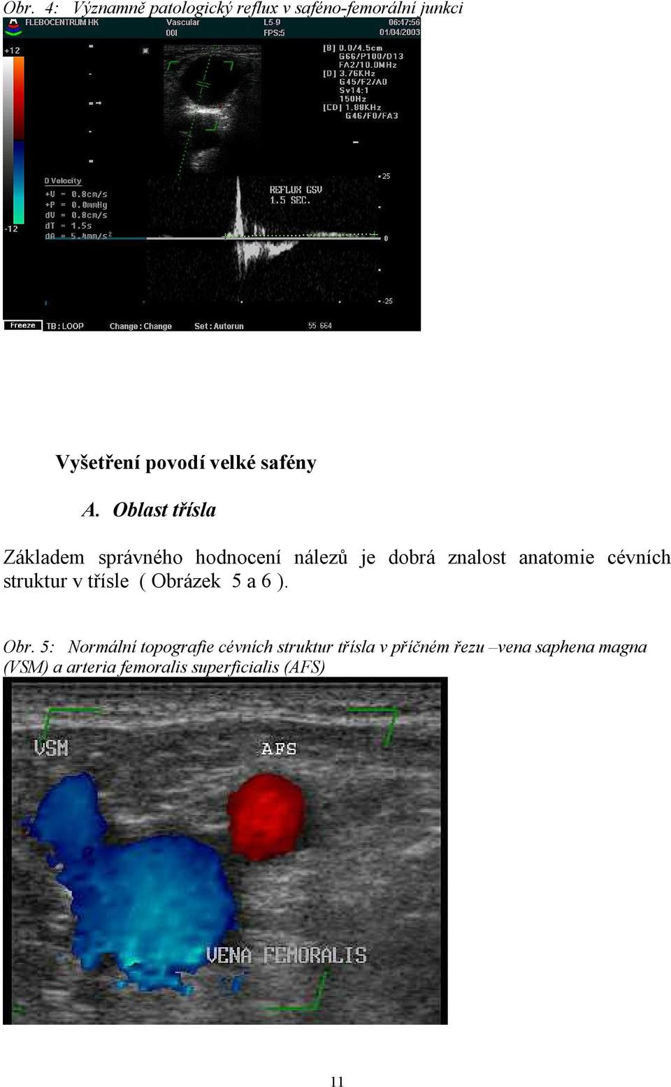 Oblast třísla Základem správného hodnocení nálezů je dobrá znalost anatomie cévních