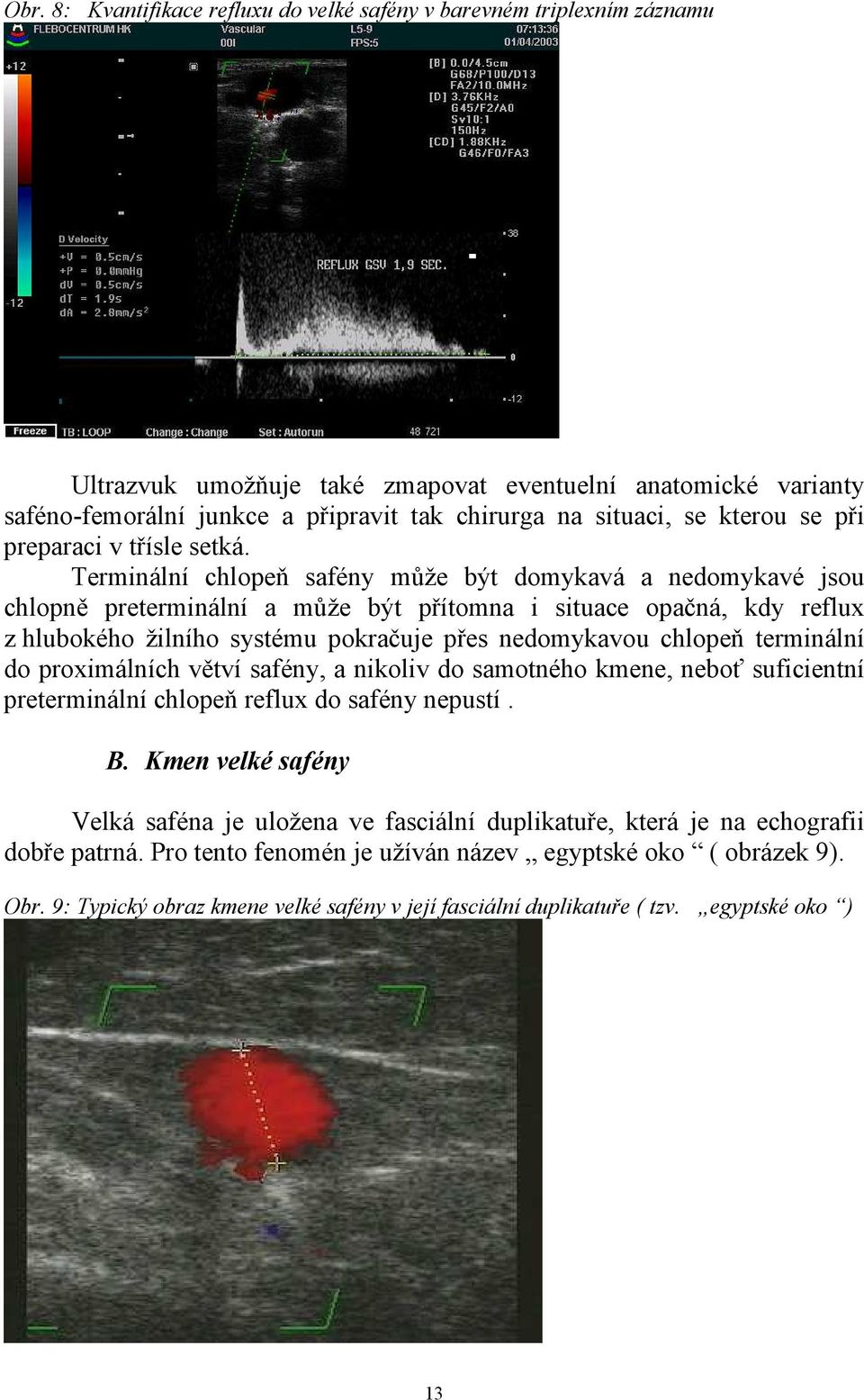 Terminální chlopeň safény může být domykavá a nedomykavé jsou chlopně preterminální a může být přítomna i situace opačná, kdy reflux z hlubokého žilního systému pokračuje přes nedomykavou chlopeň