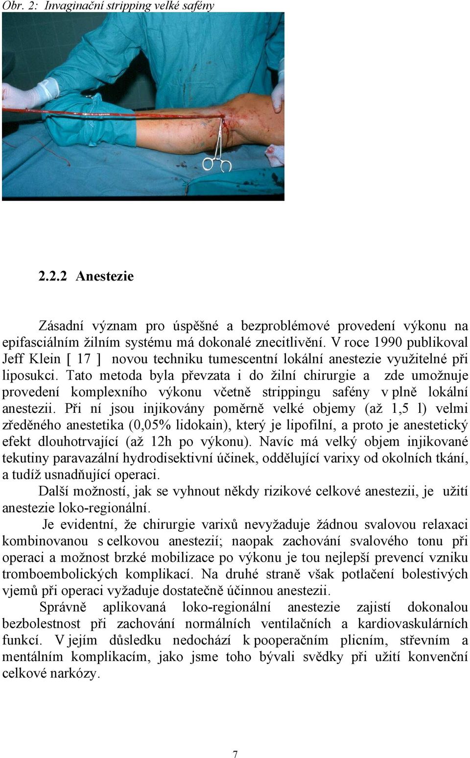 Tato metoda byla převzata i do žilní chirurgie a zde umožnuje provedení komplexního výkonu včetně strippingu safény v plně lokální anestezii.