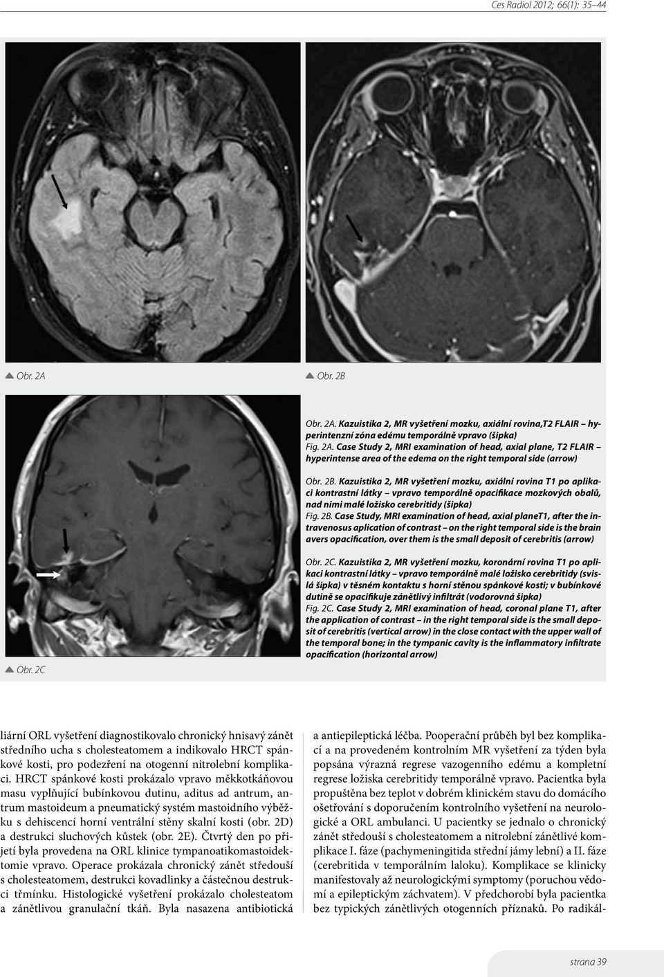 Case Study, MRI examination of head, axial planet1, after the intravenosus aplication of contrast on the right temporal side is the brain avers opacification, over them is the small deposit of