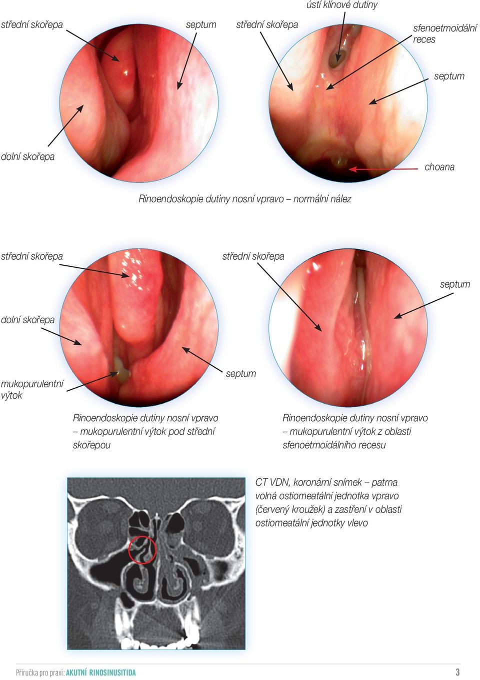 výtok pod střední skořepou Rinoendoskopie dutiny nosní vpravo mukopurulentní výtok z oblasti sfenoetmoidálního recesu CT VDN, koronární snímek