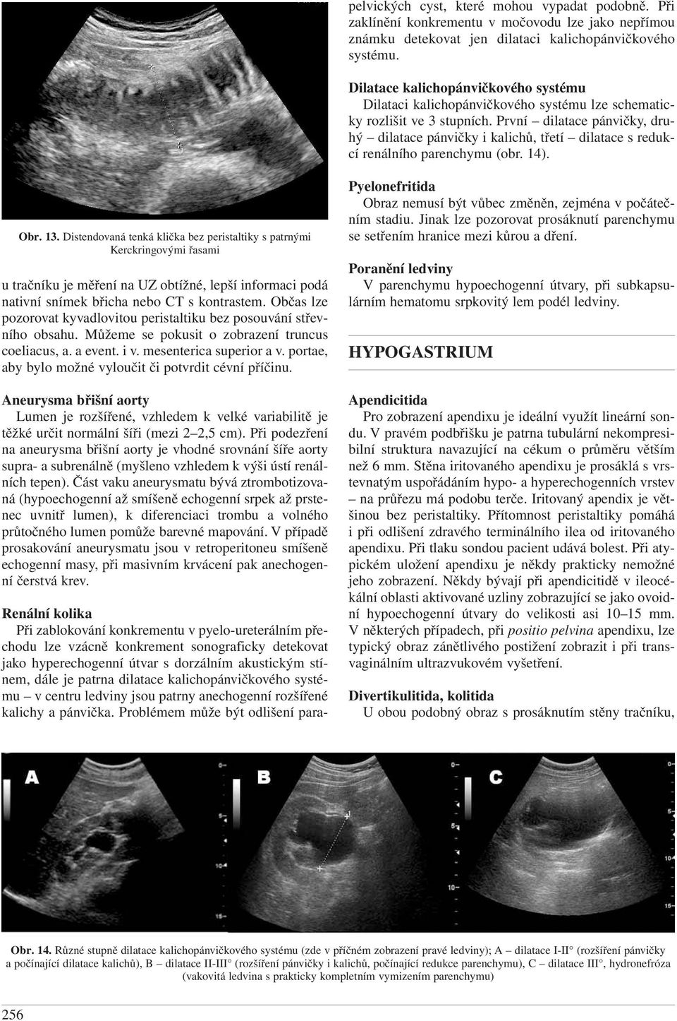 První dilatace pánvičky, druhý dilatace pánvičky i kalichů, třetí dilatace s redukcí renálního parenchymu (obr. 14). Obr. 13.