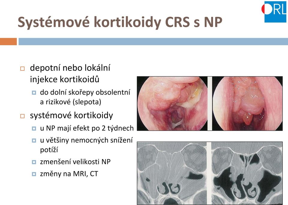 systémové kortikoidy u NP mají efekt po 2 týdnech u většiny