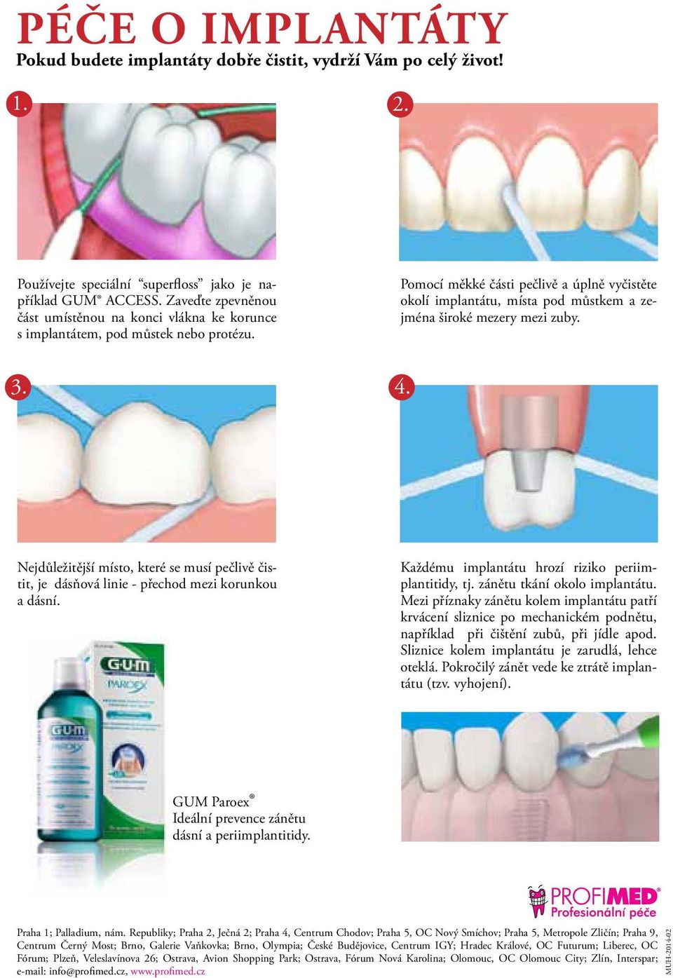 Pomocí měkké části pečlivě a úplně vyčistěte okolí implantátu, místa pod můstkem a zejména široké mezery mezi zuby. 3. 4.