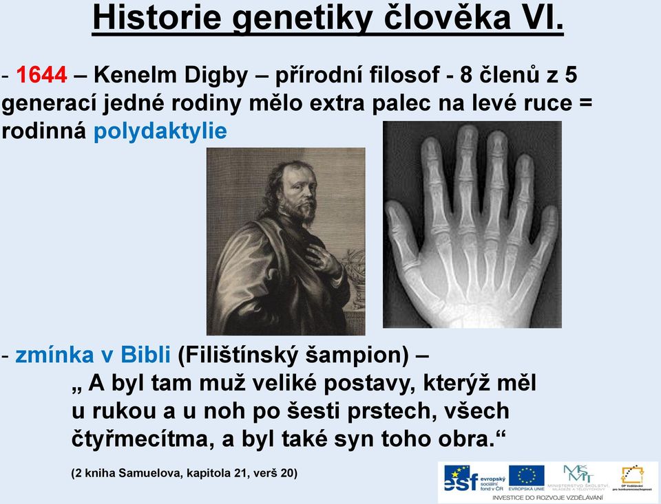 palec na levé ruce = rodinná polydaktylie - zmínka v Bibli (Filištínský šampion) A byl