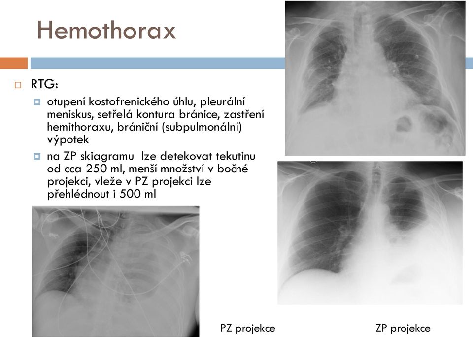ZP skiagramu lze detekovat tekutinu od cca 250 ml, menší množství v bočné