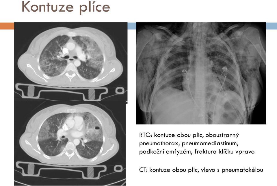 pneumomediastinum, podkožní emfyzém,