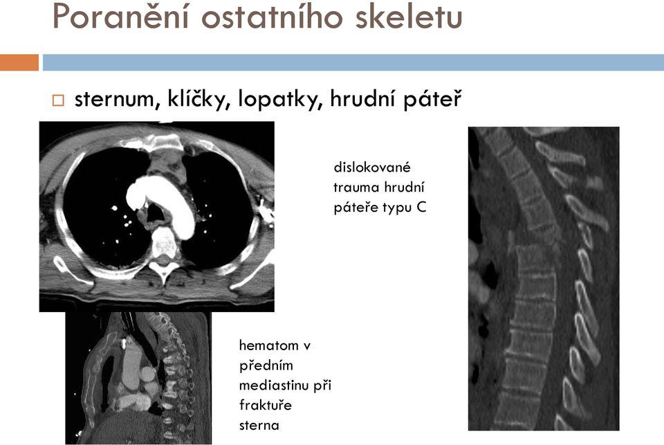 dislokované trauma hrudní páteře typu