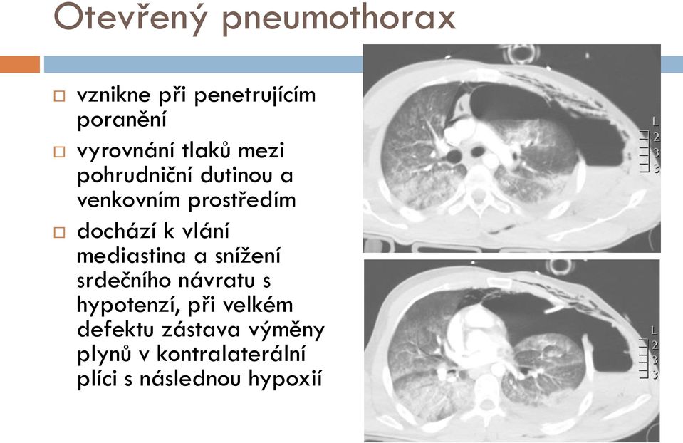 vlání mediastina a snížení srdečního návratu s hypotenzí, při