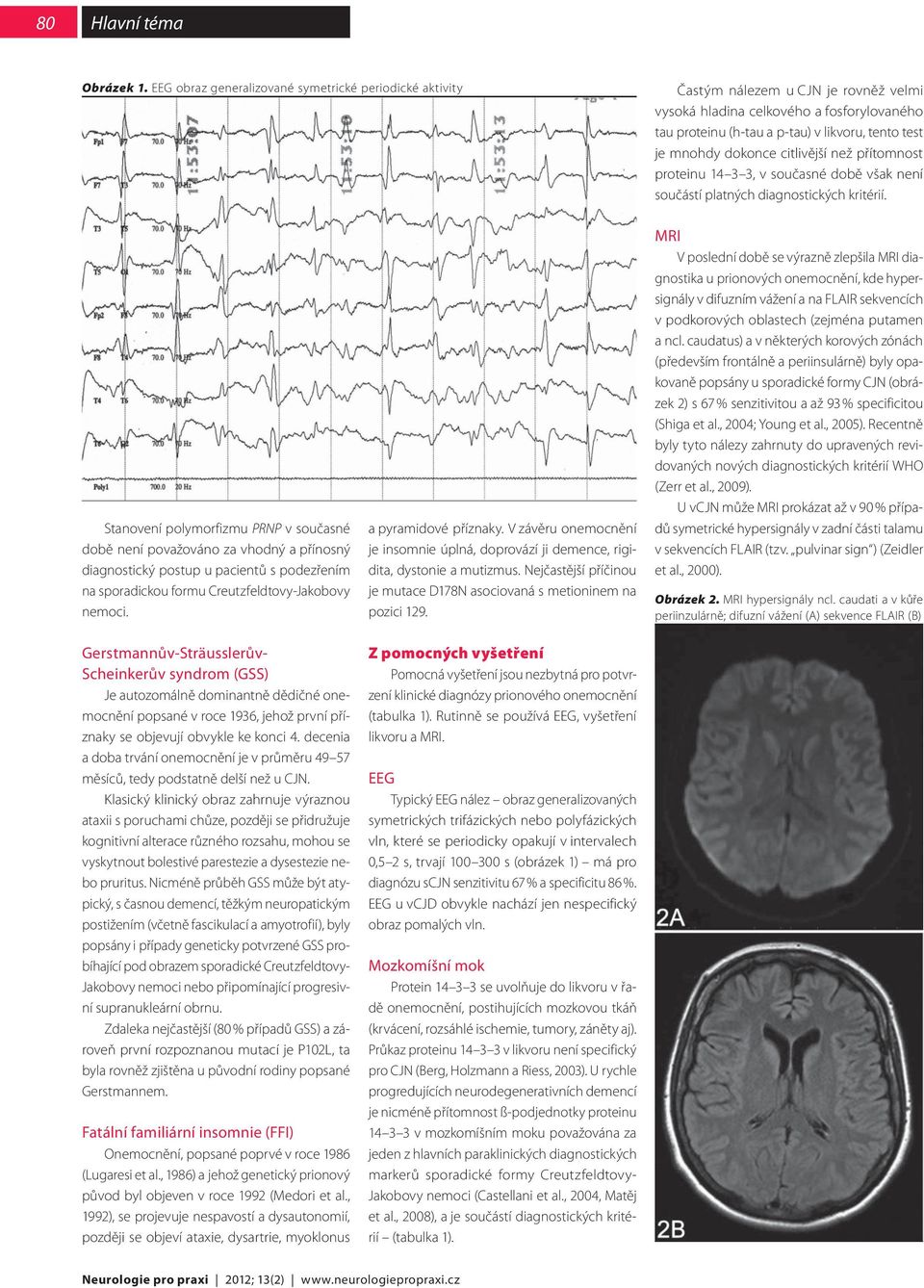 dokonce citlivější než přítomnost proteinu 14 3 3, v současné době však není součástí platných diagnostických kritérií.