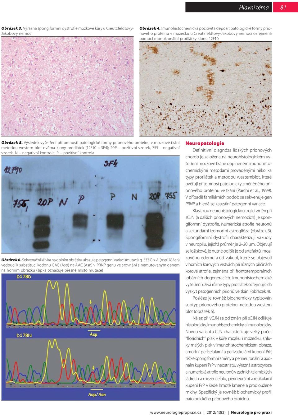 Výsledek vyšetření přítomnosti patologické formy prionového proteinu v mozkové tkáni metodou western blot dvěma klony protilátek (12F10 a 3F4); 20P pozitivní vzorek, 755 negativní vzorek, N negativní