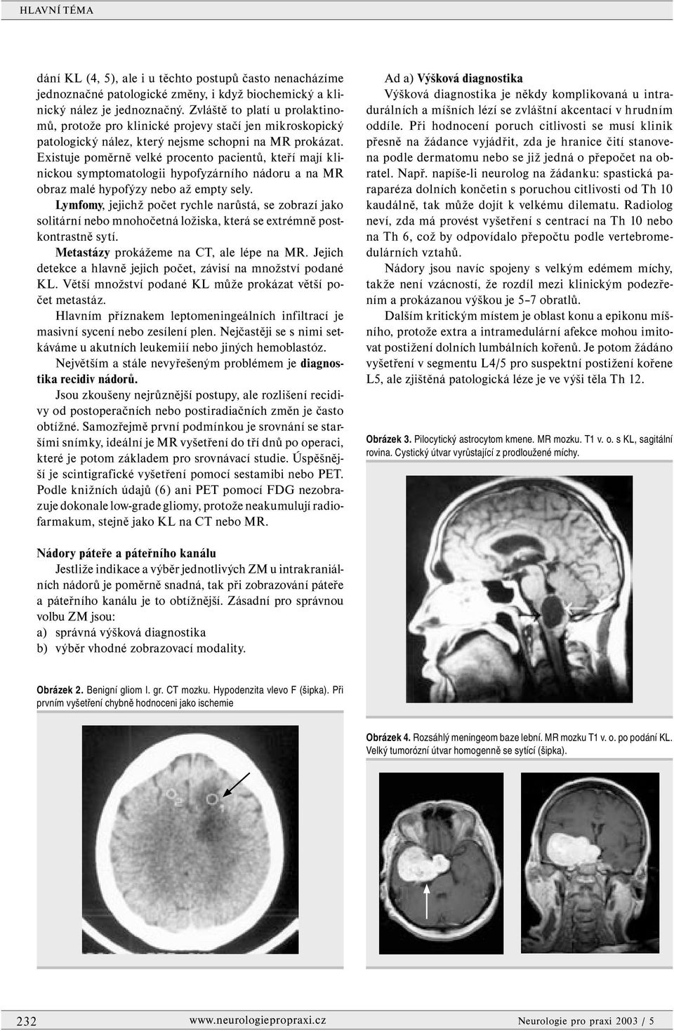 Existuje poměrně velké procento pacientů, kteří mají klinickou symptomatologii hypofyzárního nádoru a na MR obraz malé hypofýzy nebo až empty sely.