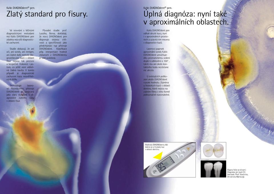 V tomto případě je diagnostické zachycení kazu neuvěřitelných 90%. Technologie laserové fluorescence přístroje DIAGNOdent je uznávaná jako zlatý standard v diagnostice zubního kazu v oblasti fisur.