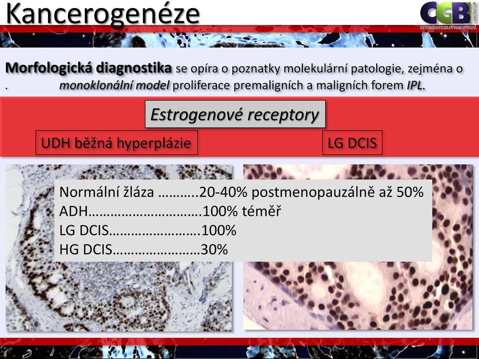 monoklonální model proliferace premaligních a maligních forem IPL.