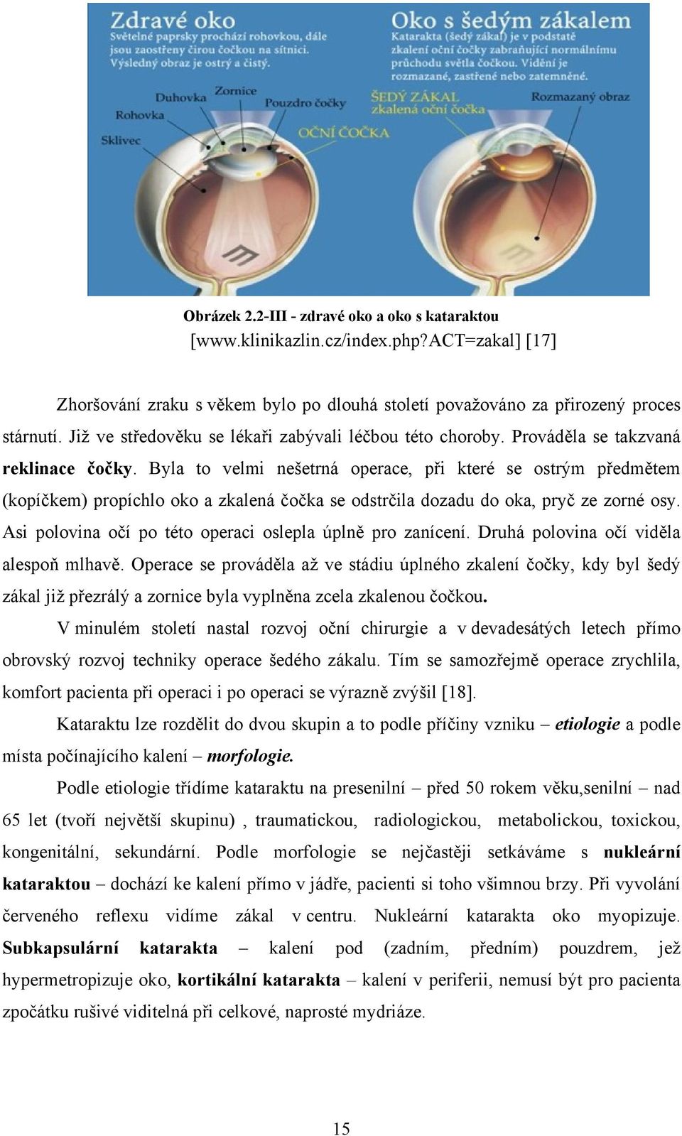 Byla to velmi nešetrná operace, při které se ostrým předmětem (kopíčkem) propíchlo oko a zkalená čočka se odstrčila dozadu do oka, pryč ze zorné osy.