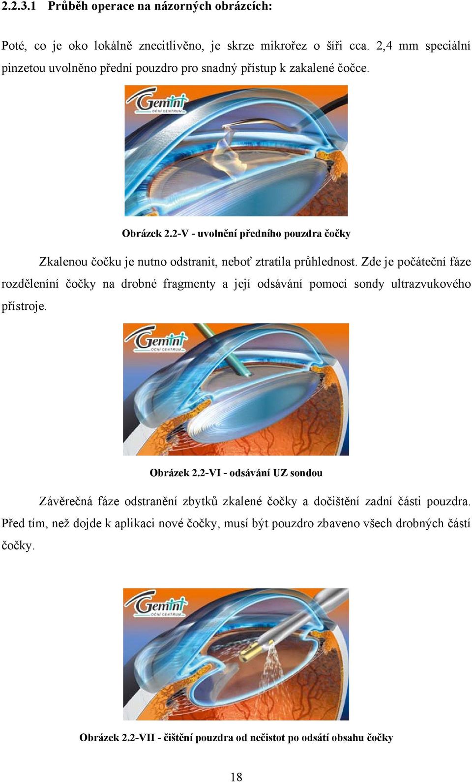 2-V - uvolnění předního pouzdra čočky Zkalenou čočku je nutno odstranit, neboť ztratila průhlednost.