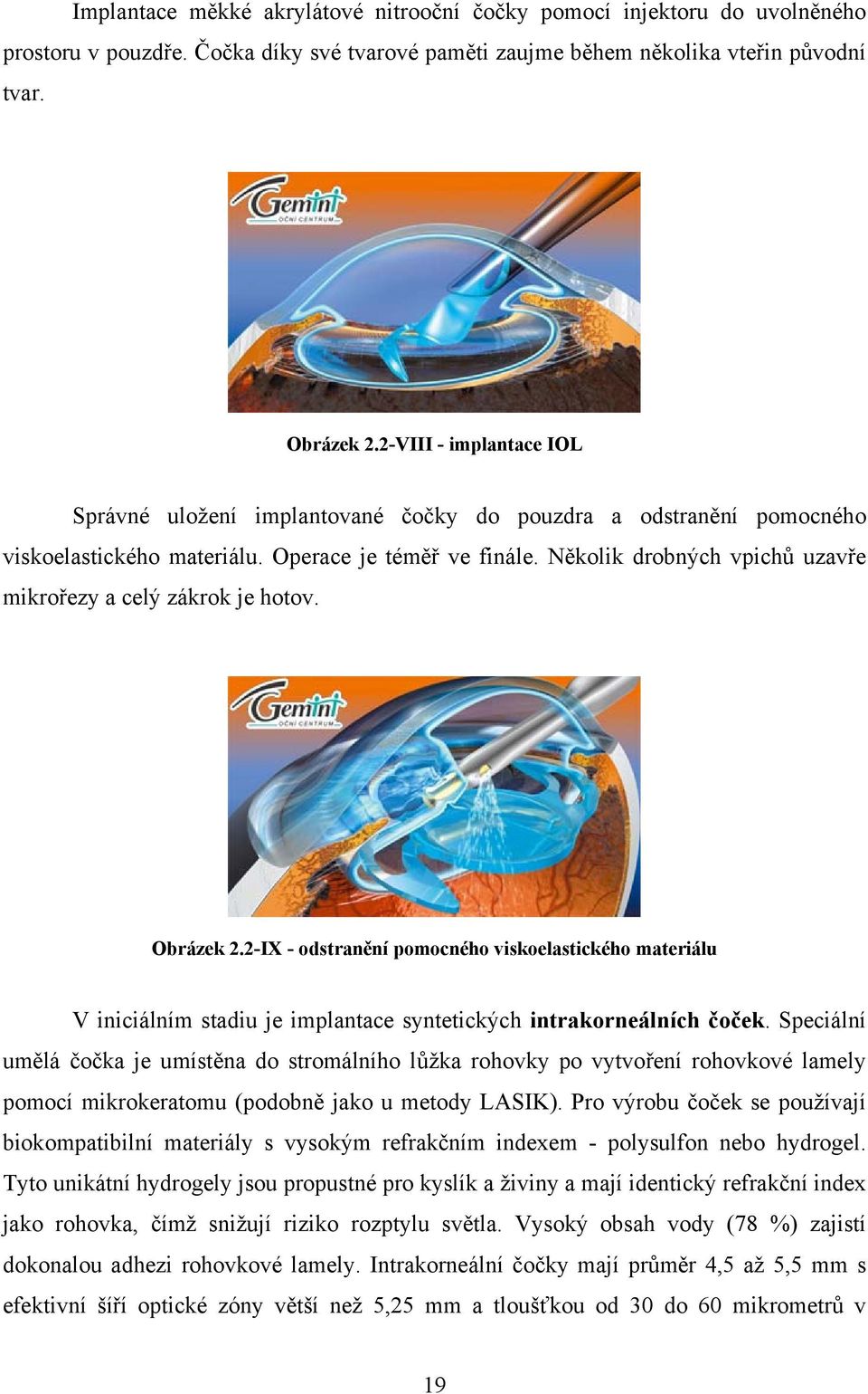 Několik drobných vpichů uzavře mikrořezy a celý zákrok je hotov. Obrázek 2.2-IX - odstranění pomocného viskoelastického materiálu V iniciálním stadiu je implantace syntetických intrakorneálních čoček.