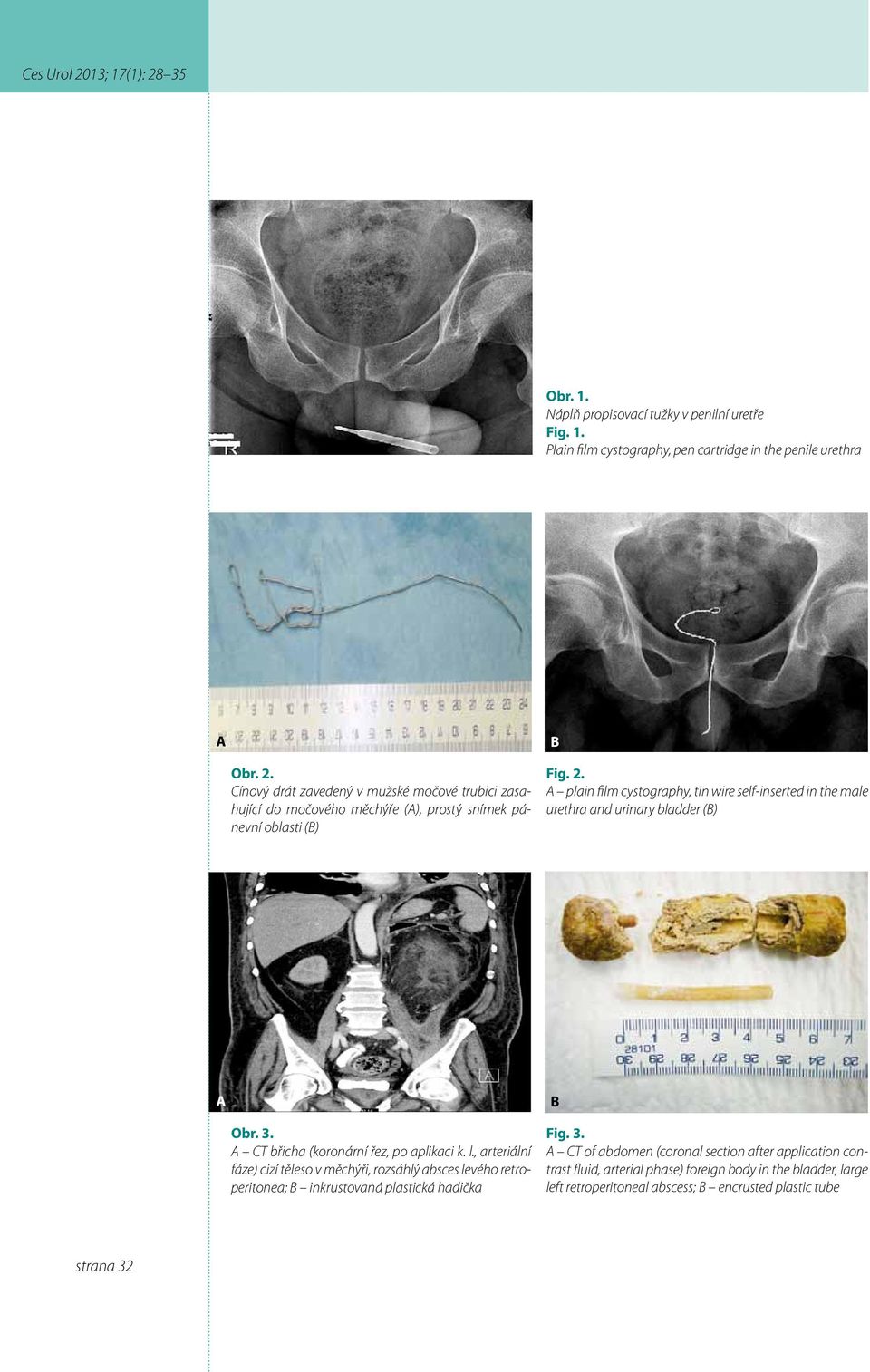 A plain film cystography, tin wire self-inserted in the male urethra and urinary bladder (B) A B Obr. 3. A CT břicha (koronární řez, po aplikaci k. l.