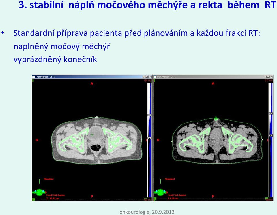 pacienta před plánováním a každou