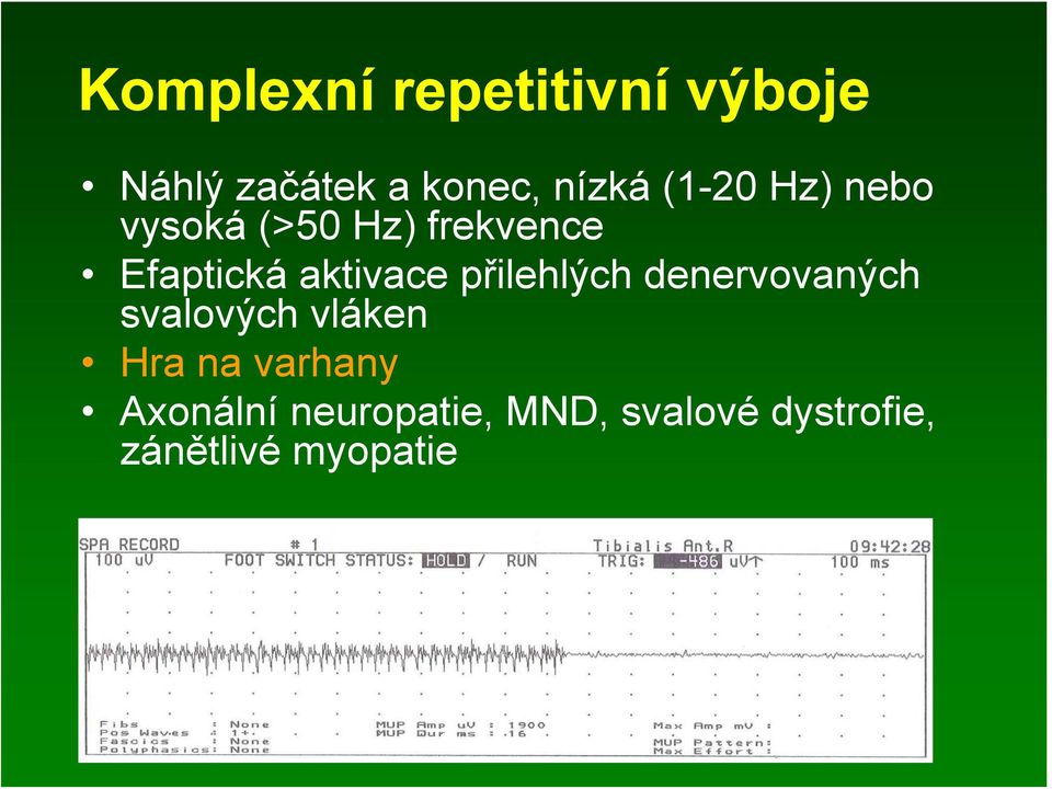 přilehlých denervovaných svalových vláken Hra na varhany