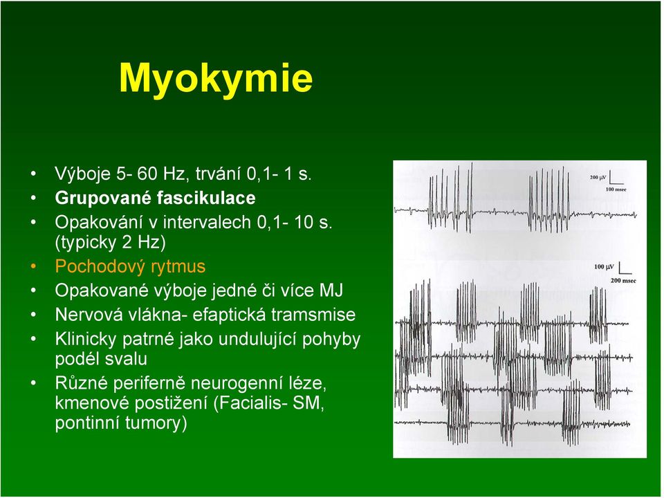 (typicky 2 Hz) Pochodový rytmus Opakované výboje jedné či více MJ Nervová vlákna-