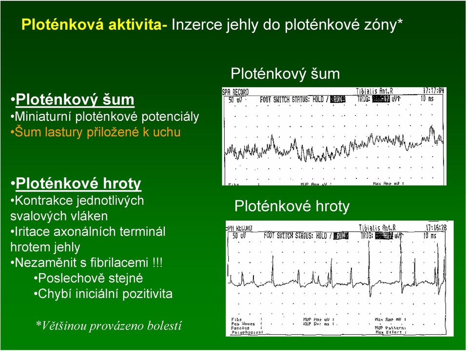 Kontrakce jednotlivých svalových vláken Iritace axonálních terminál hrotem jehly Nezaměnit