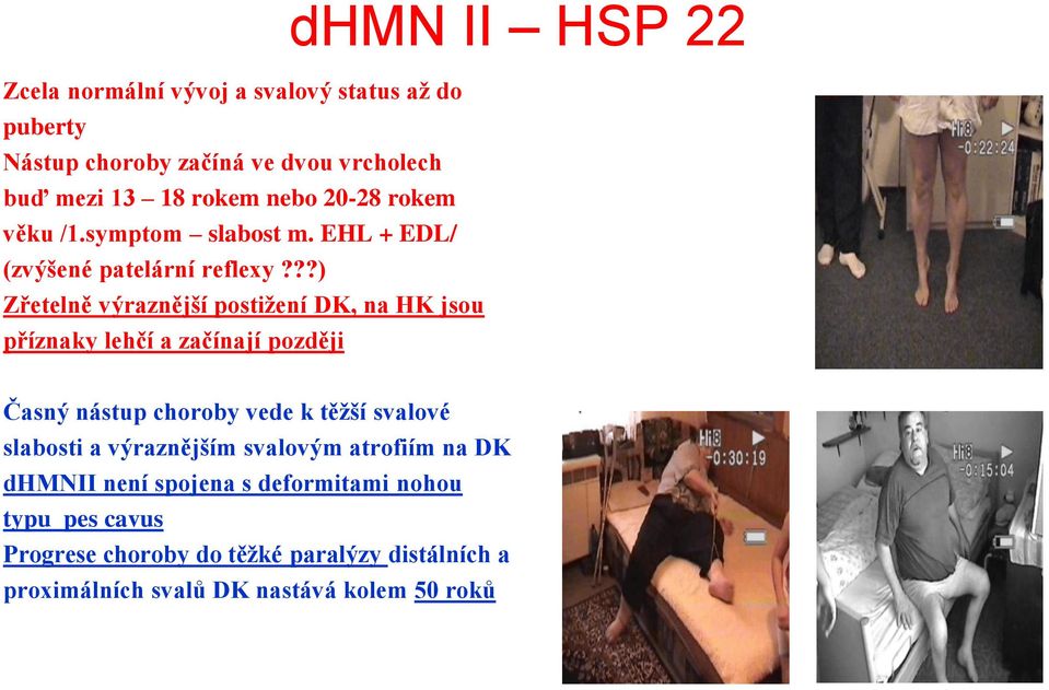 ??) Zřetelně výraznější postižení DK, na HK jsou příznaky lehčí a začínají později dhmn II HSP 22 Časný nástup choroby vede k těžší