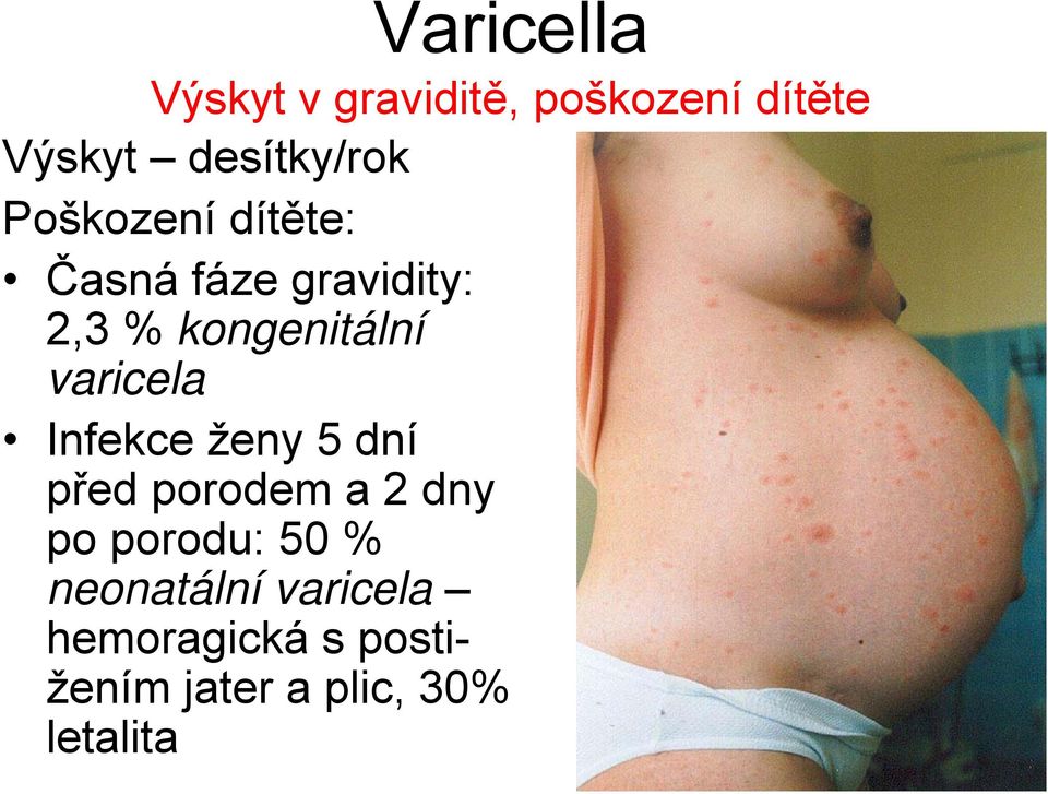 varicela Infekce ženy 5 dní před porodem a 2 dny po porodu: 50 %