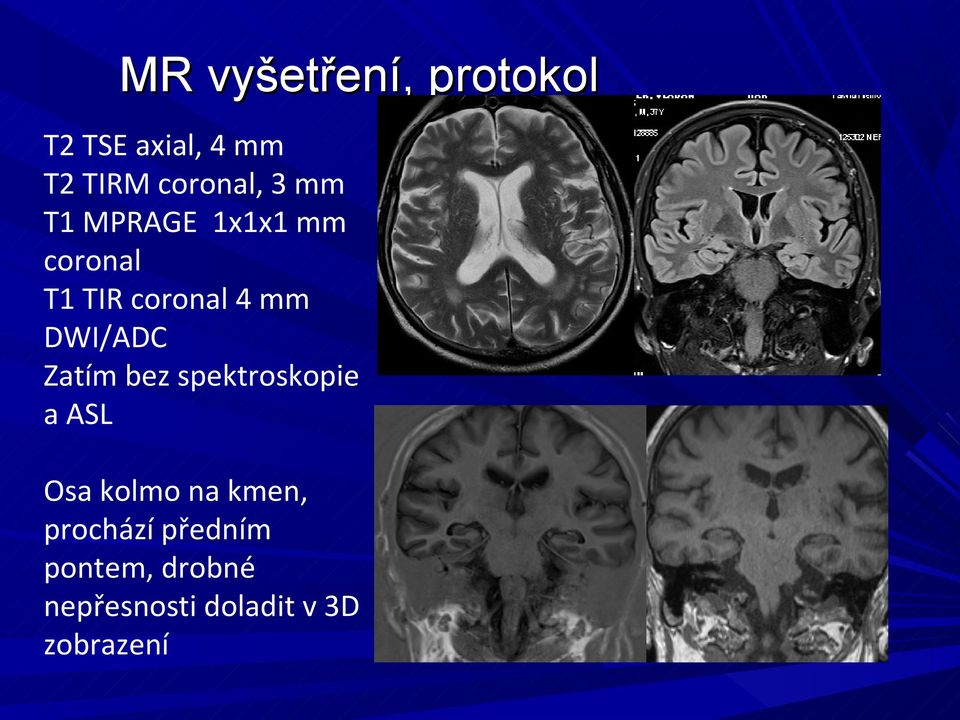 DWI/ADC Zatím bez spektroskopie a ASL Osa kolmo na kmen,