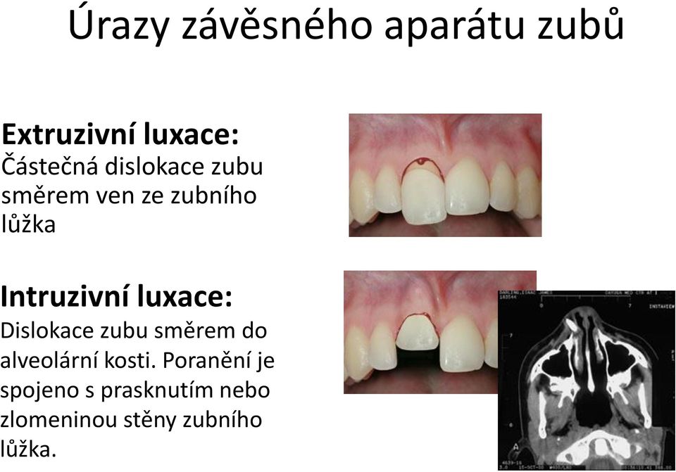 luxace: Dislokace zubu směrem do alveolární kosti.