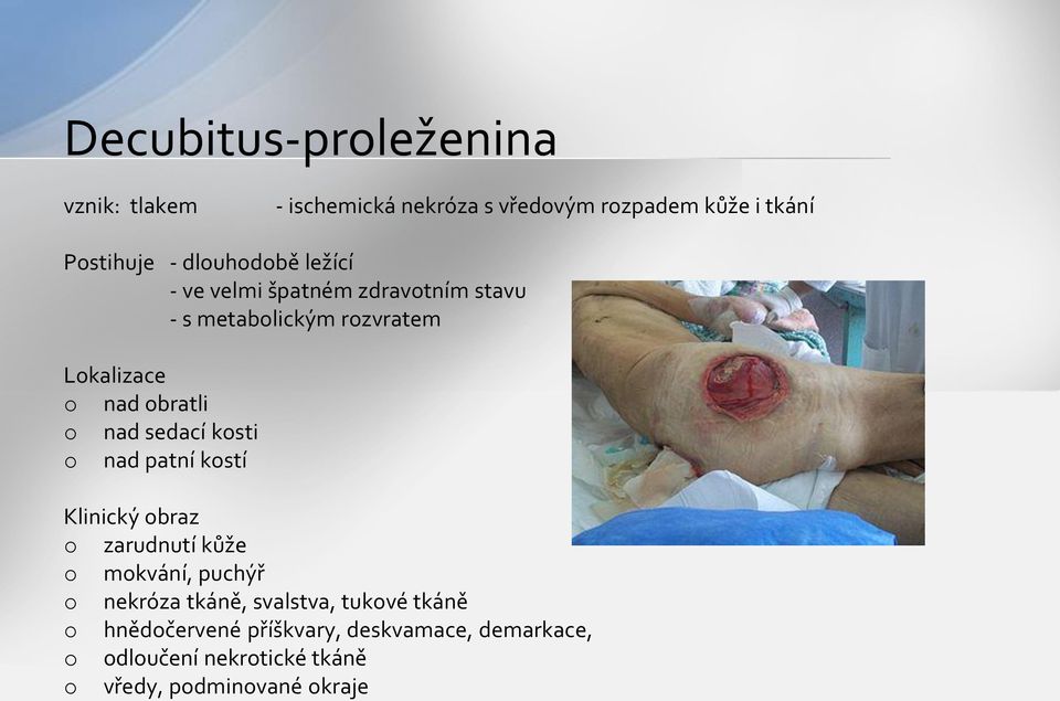 nad sedací kosti o nad patní kostí Klinický obraz o zarudnutí kůže o mokvání, puchýř o nekróza tkáně,