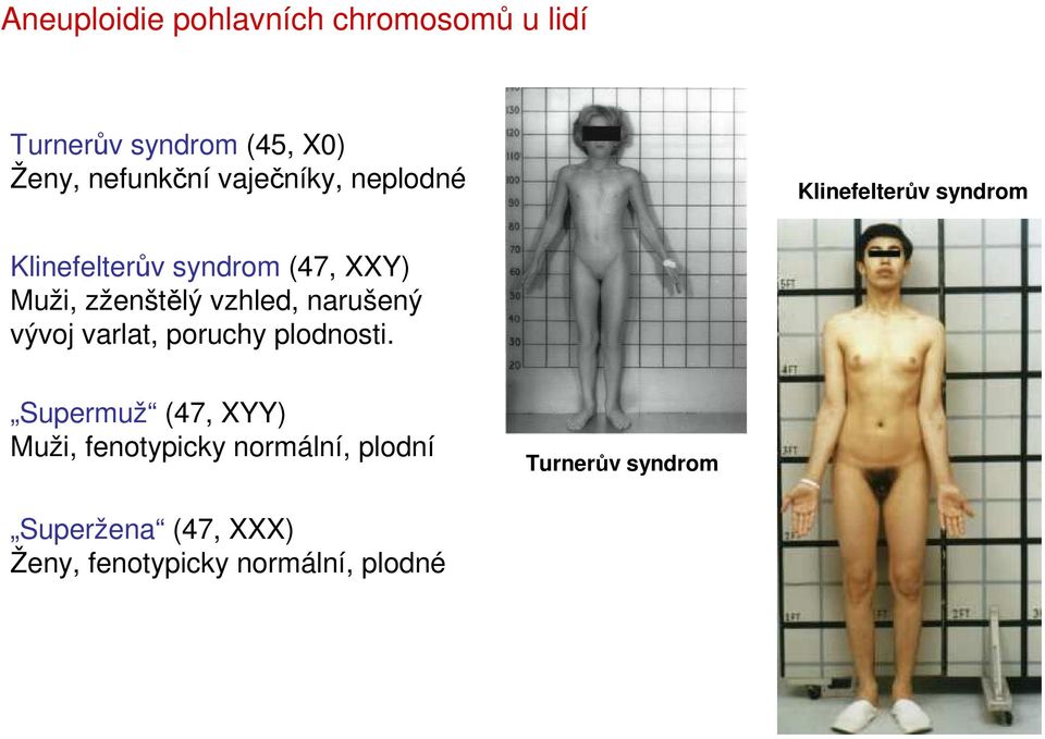 zženštělý vzhled, narušený vývoj varlat, poruchy plodnosti.